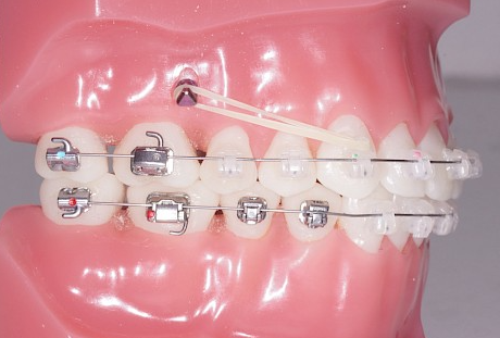 minivis dentaires